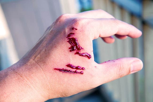 Hand with multiple bite marks