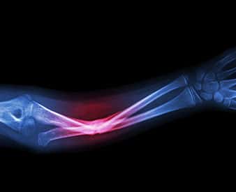 Radiografía de lesión ósea rota