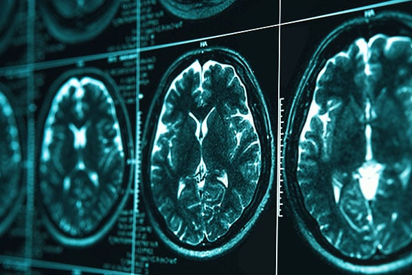 MRI images of brain damage after a head injury