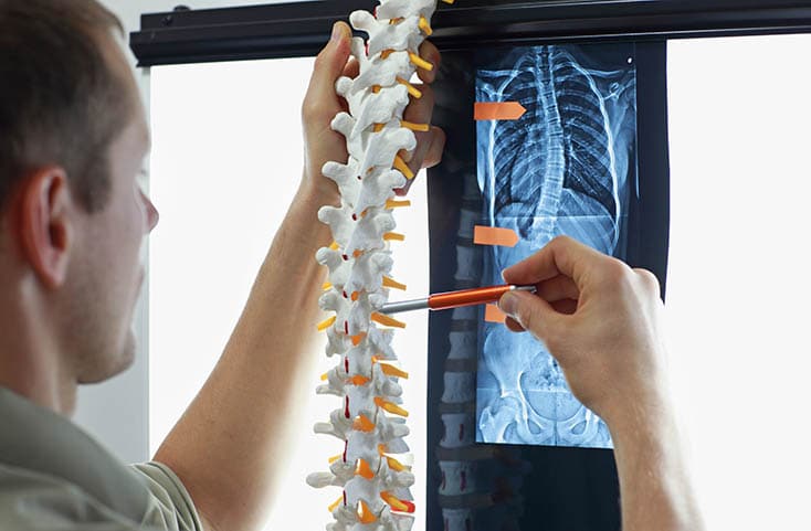 Doctor examining x-ray of herniated disk injury