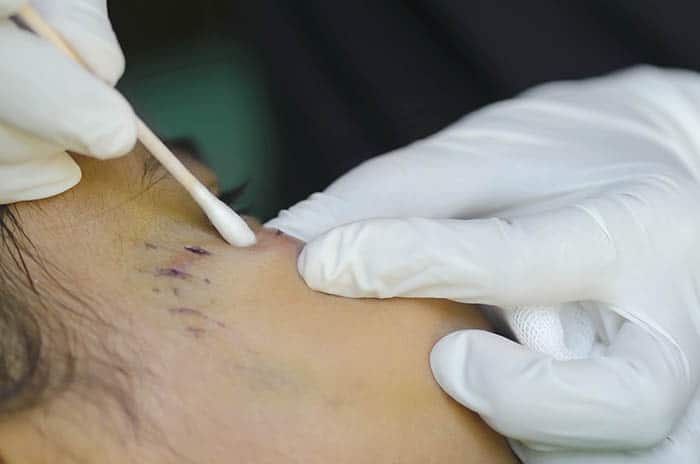 Doctor treating facial dog bite wound
