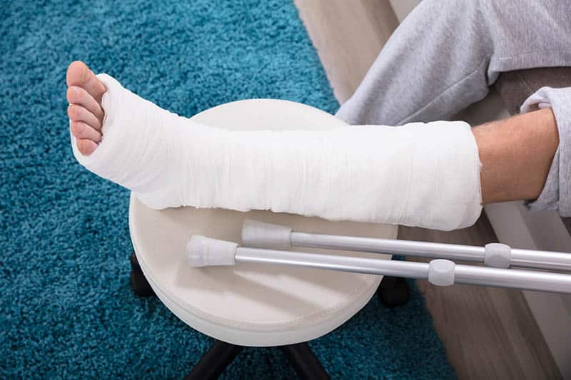 Broken bone injury victim with cast on leg