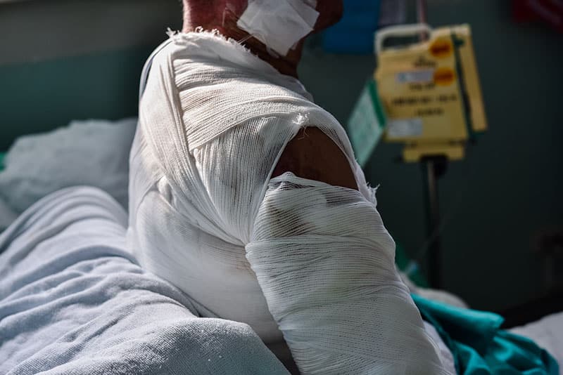 Burn injury victim wrapped in bandages