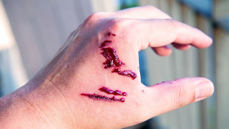 Lesión por mordedura de perro en la mano